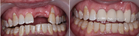可以把全部牙齿做成种植牙吗 可以把全部牙齿做成种植牙吗